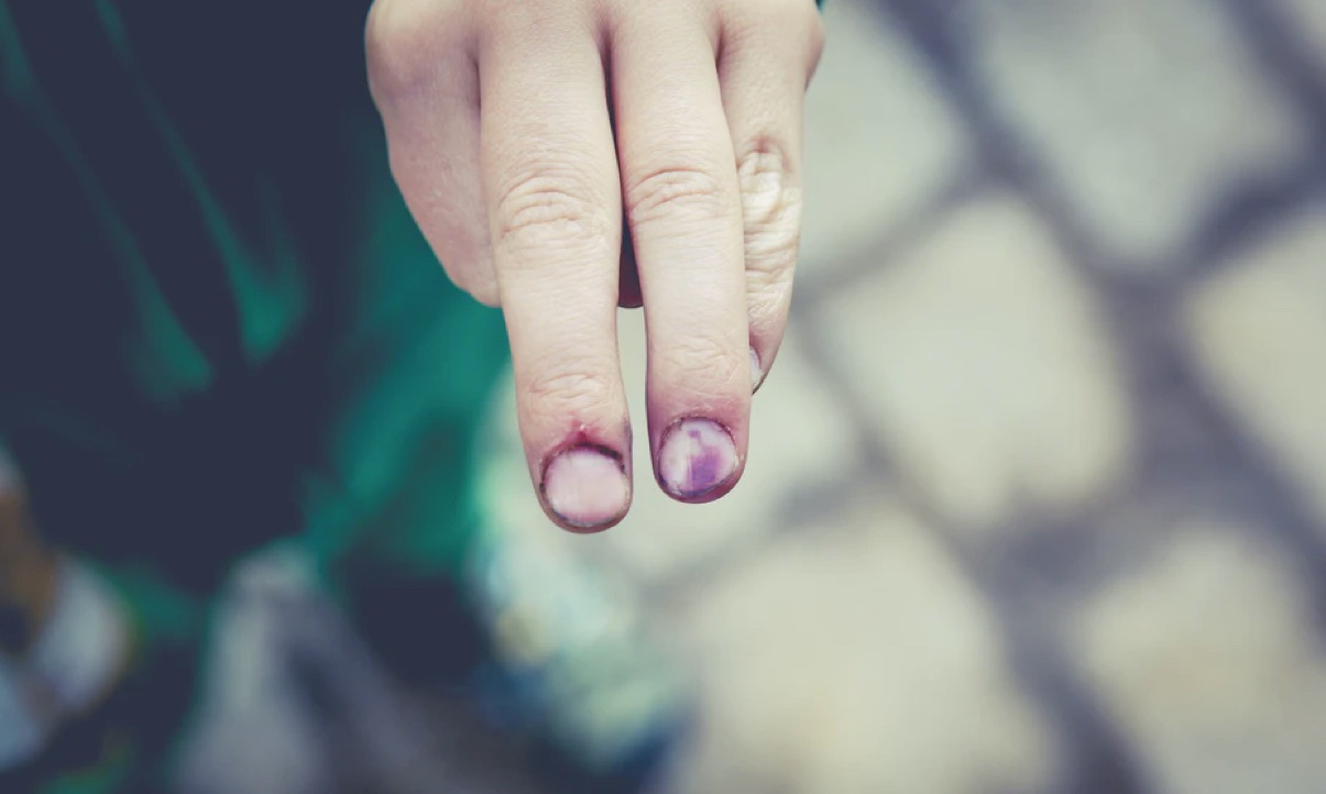 Skin Signs in Child Abuse